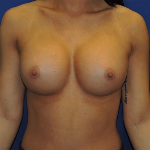 Breast Augmentation before and after, case 7644 - Cool Springs Plastic Surgery