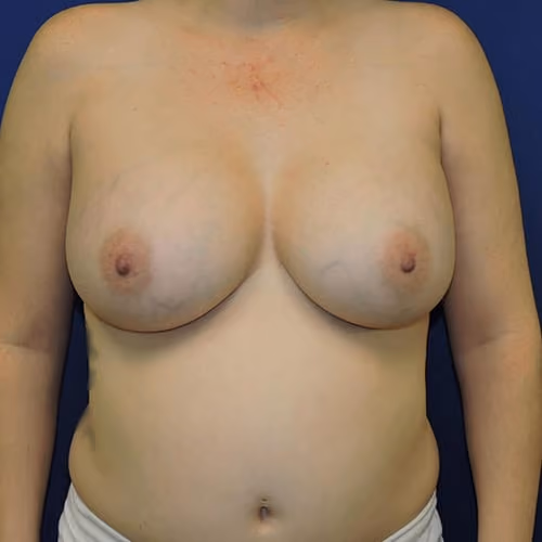 Breast Augmentation before and after, case 7609 - Cool Springs Plastic Surgery