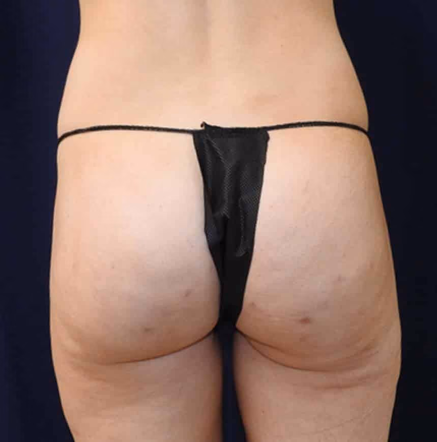 Liposuction after photo, case 8187 - Cool Springs Plastic Surgery