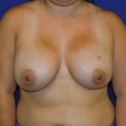 Breast Augmentation before and after, case 7303 - Cool Springs Plastic Surgery