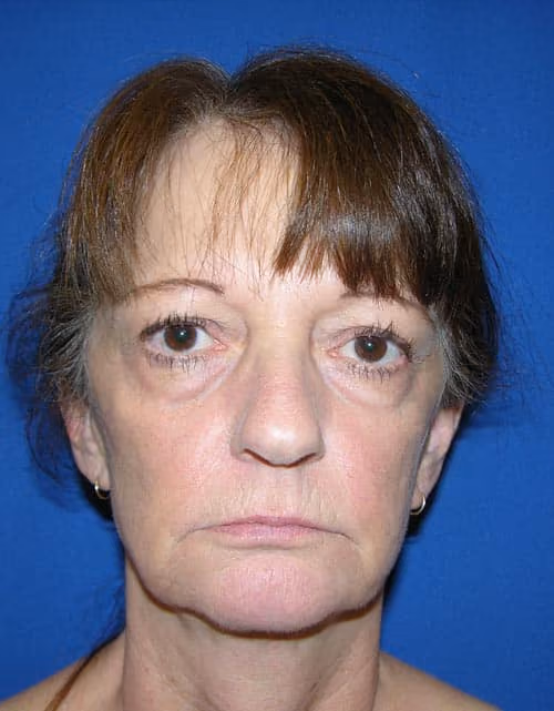 Facial Fat Grafting before photo, case 4462 - Cool Springs Plastic Surgery