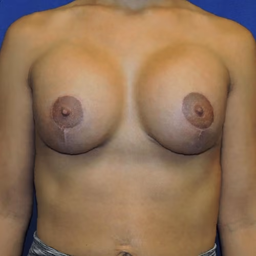 Breast Lift + Augmentation before and after, case 4087 - Cool Springs Plastic Surgery