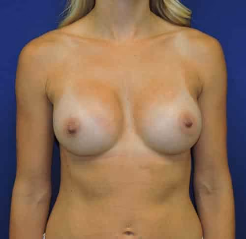 Breast Augmentation before and after, case 3727 - Cool Springs Plastic Surgery