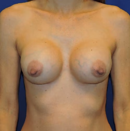 Breast Augmentation before and after, case 7153 - Cool Springs Plastic Surgery