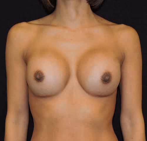 Breast Augmentation before and after, case 7129 - Cool Springs Plastic Surgery