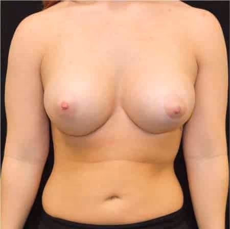 Breast Augmentation before and after, case 6891 - Cool Springs Plastic Surgery