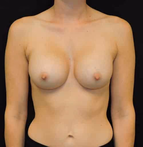 Breast Augmentation before and after, case 6837 - Cool Springs Plastic Surgery