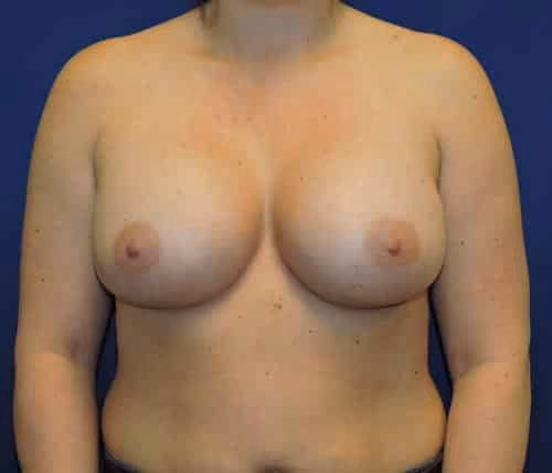 Breast Augmentation before and after, case 6795 - Cool Springs Plastic Surgery