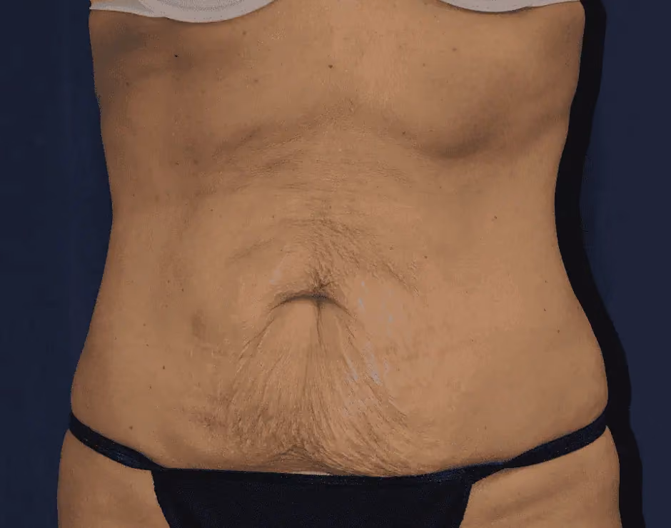 Liposuction before photo, case 12842 - Cool Springs Plastic Surgery
