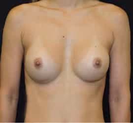 Breast Augmentation before and after, case 6222 - Cool Springs Plastic Surgery