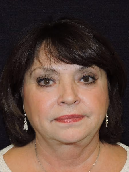 Facelift before photo, case 3288 - Cool Springs Plastic Surgery