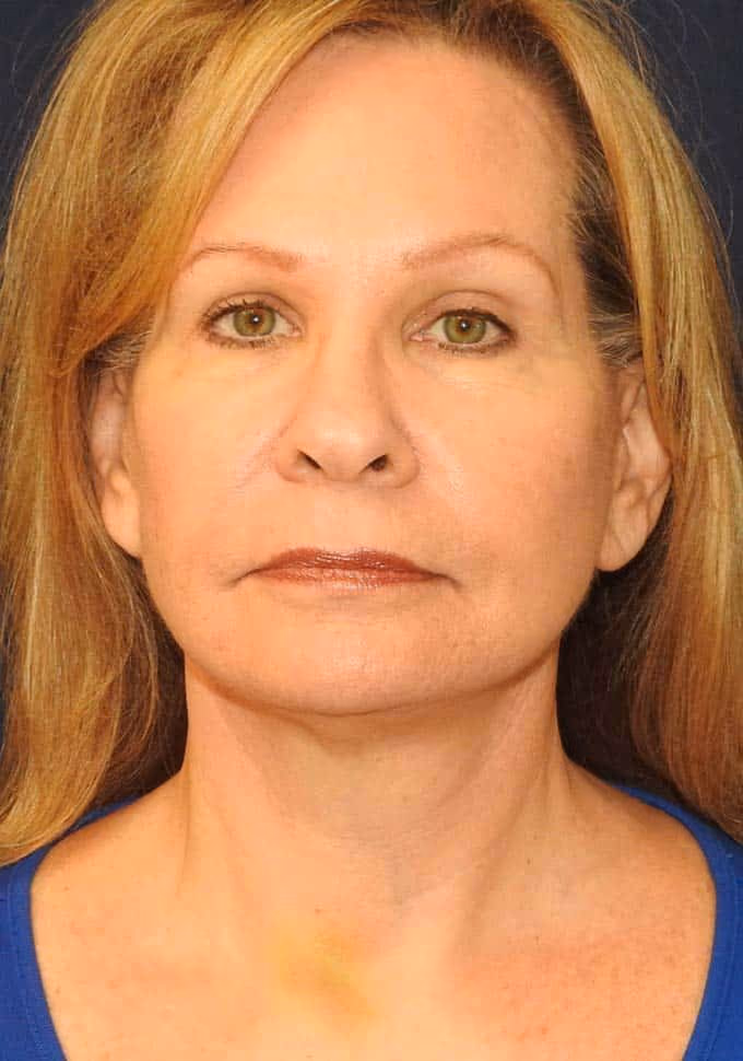 Facial Fat Grafting after photo, case 3282 - Cool Springs Plastic Surgery