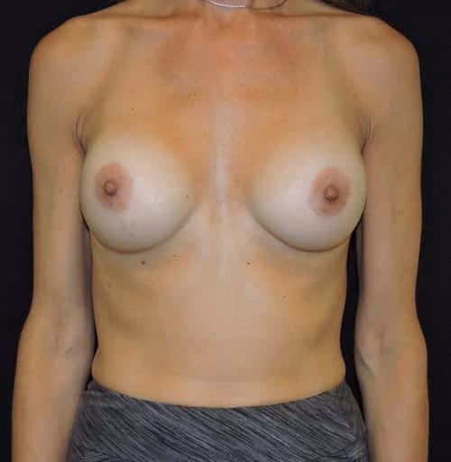 Breast Augmentation before and after, case 6182 - Cool Springs Plastic Surgery