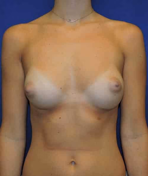 Breast Augmentation before and after, case 5991 - Cool Springs Plastic Surgery