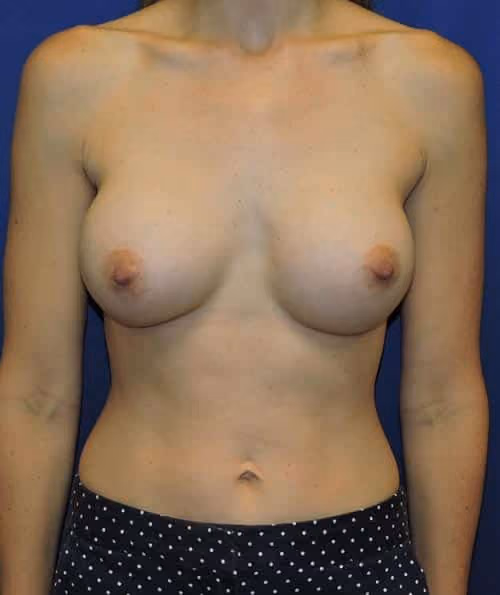 Breast Augmentation before and after, case 5950 - Cool Springs Plastic Surgery