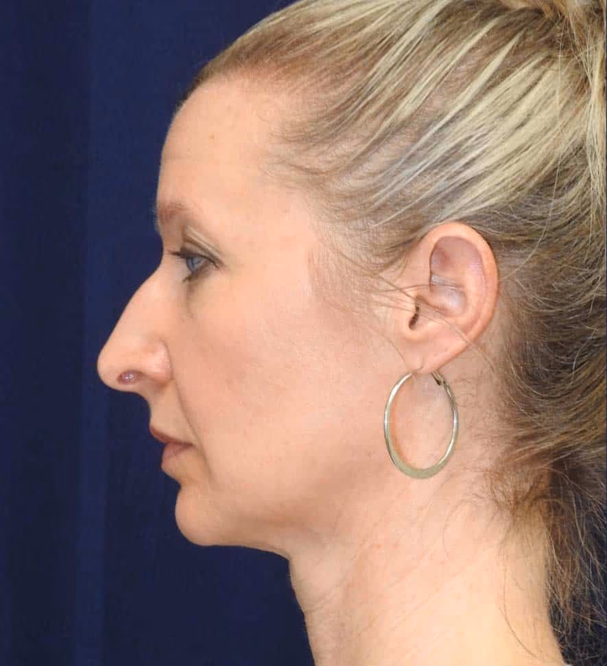 Rhinoplasty before photo, case 2401 - Cool Springs Plastic Surgery