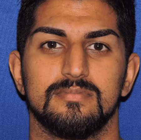 Rhinoplasty before photo, case 2861 - Cool Springs Plastic Surgery