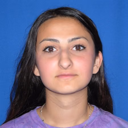 Rhinoplasty before photo, case 2877 - Cool Springs Plastic Surgery
