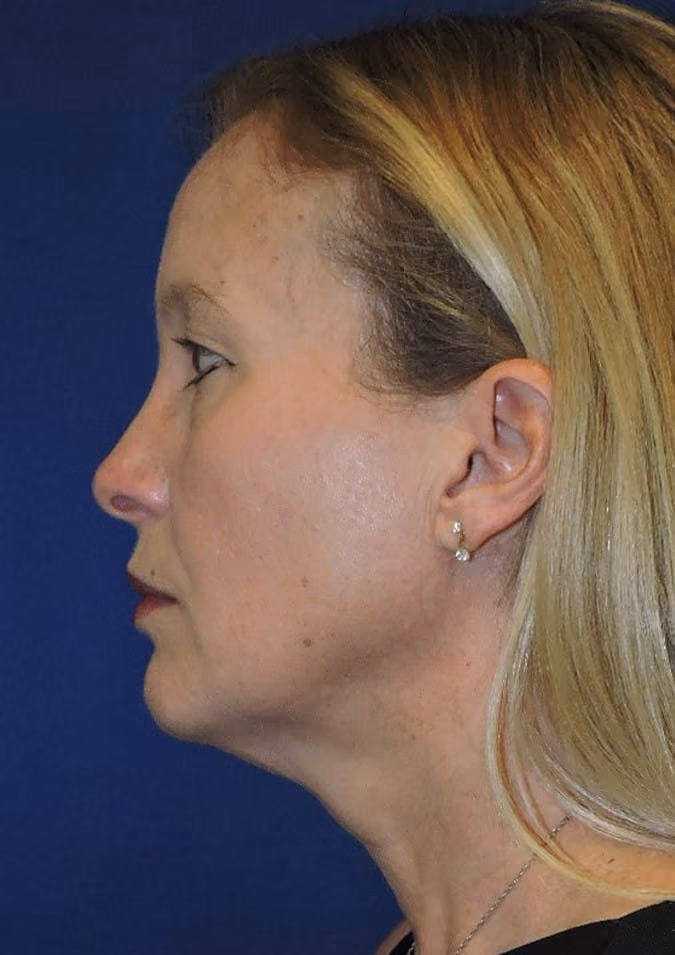 Facelift before photo, case 2892 - Cool Springs Plastic Surgery