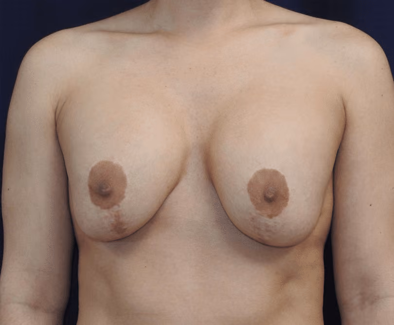 Breast Implant Revision before photo, case 1003 - Cool Springs Plastic Surgery