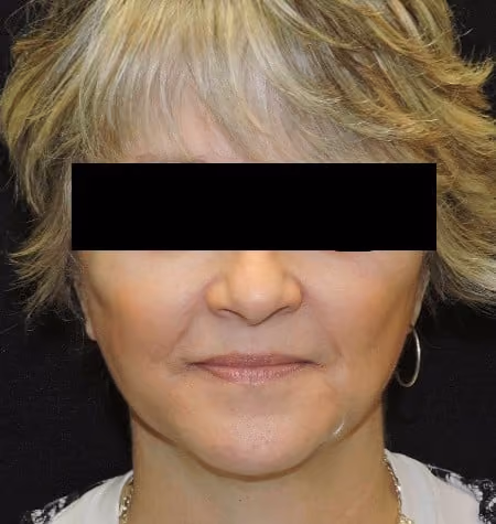Facial Fat Grafting after photo, case 2857 - Cool Springs Plastic Surgery