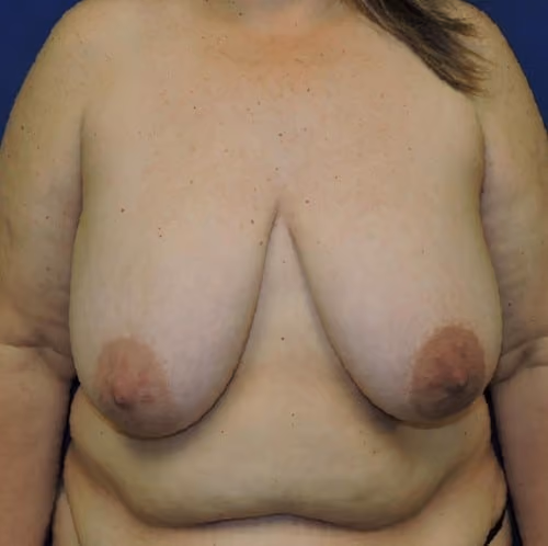 Breast Reduction before photo, case 2813 - Cool Springs Plastic Surgery