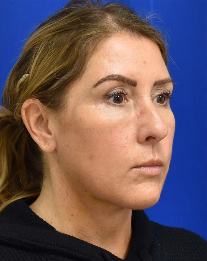 Liposuction after photo, case 2005 - Cool Springs Plastic Surgery