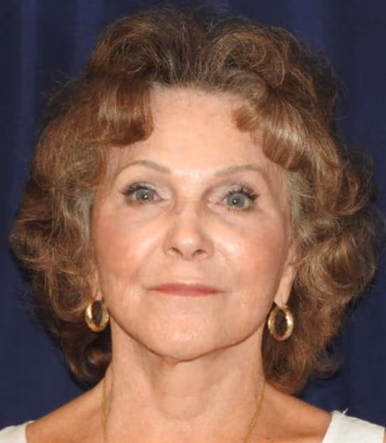 Facial Fat Grafting after photo, case 2632 - Cool Springs Plastic Surgery