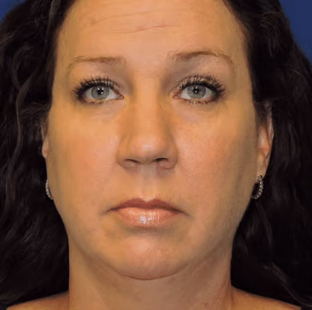 Rhinoplasty before photo, case 3041 - Cool Springs Plastic Surgery