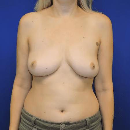 Breast Implant Revision after photo, case 1255 - Cool Springs Plastic Surgery