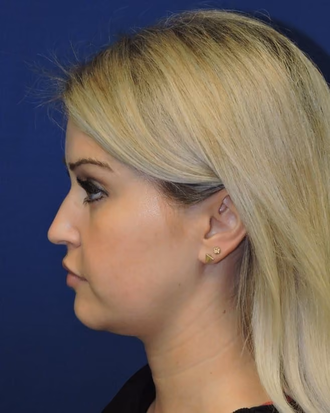 Liposuction before photo, case 2127 - Cool Springs Plastic Surgery