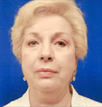 Facelift before photo, case 2483 - Cool Springs Plastic Surgery