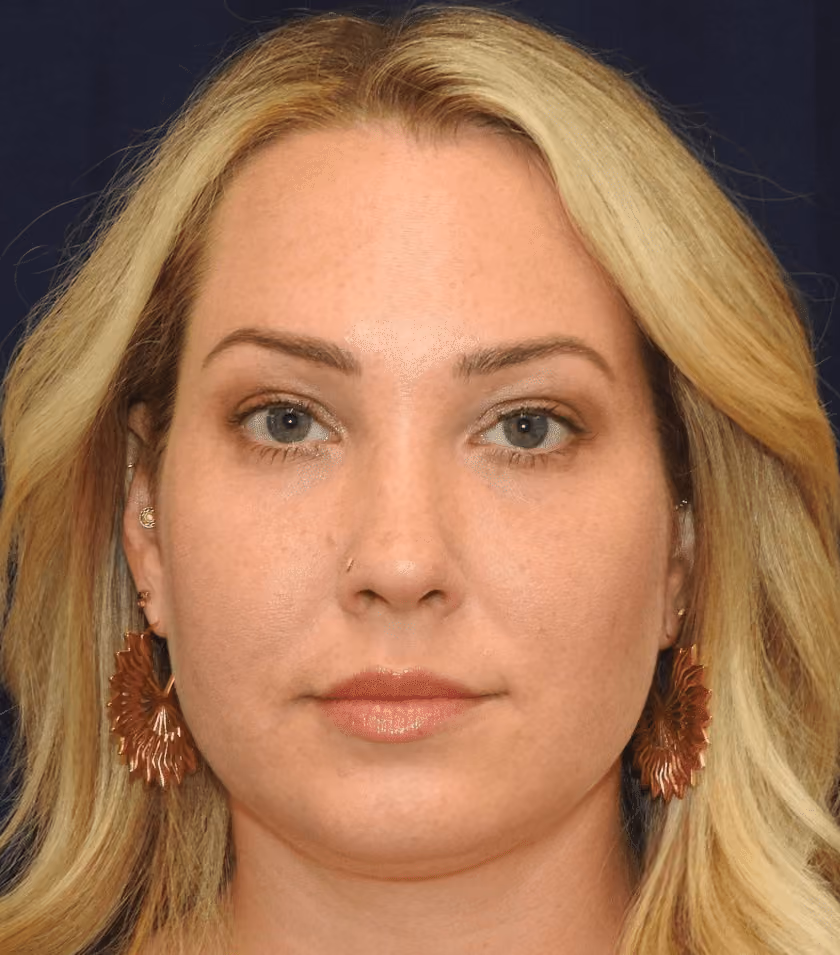Liposuction before photo, case 2334 - Cool Springs Plastic Surgery