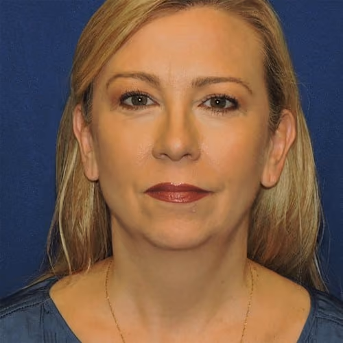 Liposuction before photo, case 2389 - Cool Springs Plastic Surgery
