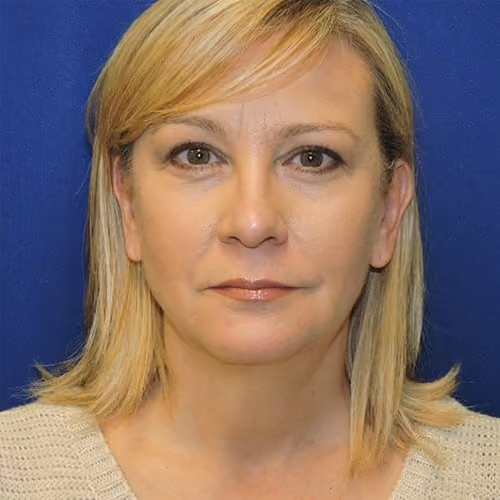 Liposuction after photo, case 2389 - Cool Springs Plastic Surgery