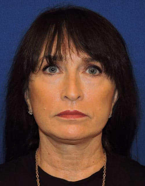 Facelift after photo, case 2364 - Cool Springs Plastic Surgery