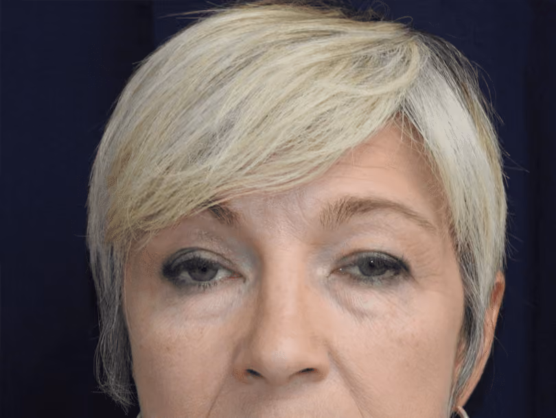 Eyelid Surgery before photo, case 1632 - Cool Springs Plastic Surgery