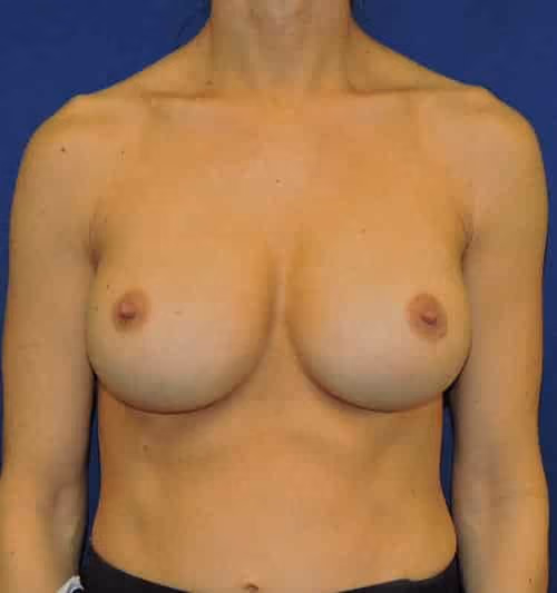 Breast Implant Revision after photo, case 1646 - Cool Springs Plastic Surgery