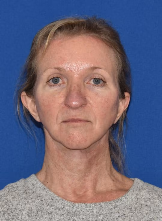 Facial Fat Grafting after photo, case 1705 - Cool Springs Plastic Surgery