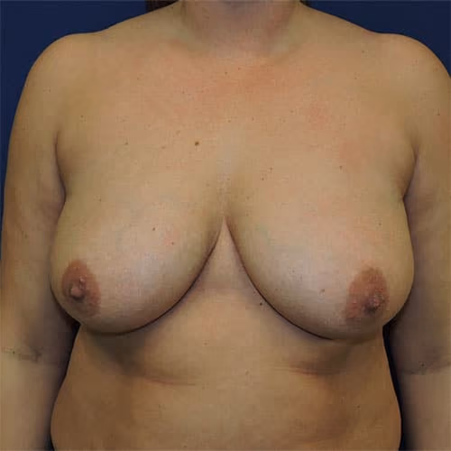 Breast Lift before photo, case 1739 - Cool Springs Plastic Surgery