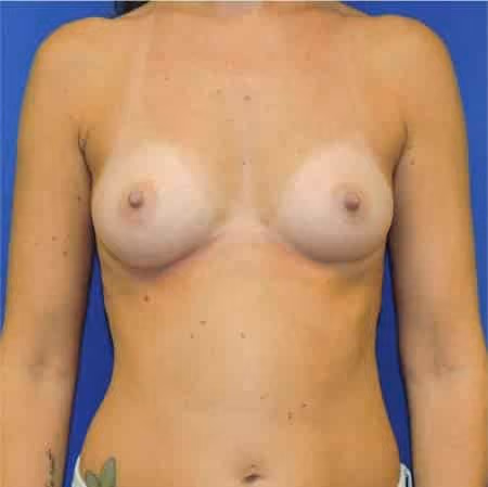 Breast Augmentation before photo, case 1777 - Cool Springs Plastic Surgery