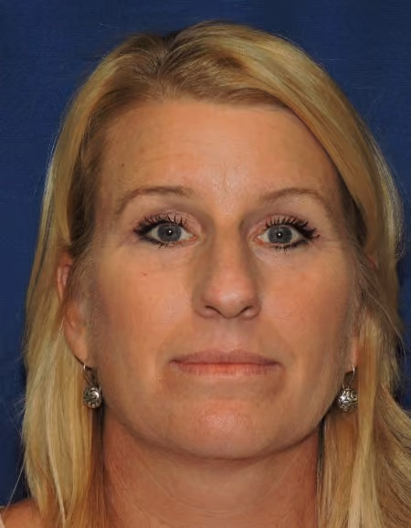 Eyelid Surgery after photo, case 1807 - Cool Springs Plastic Surgery