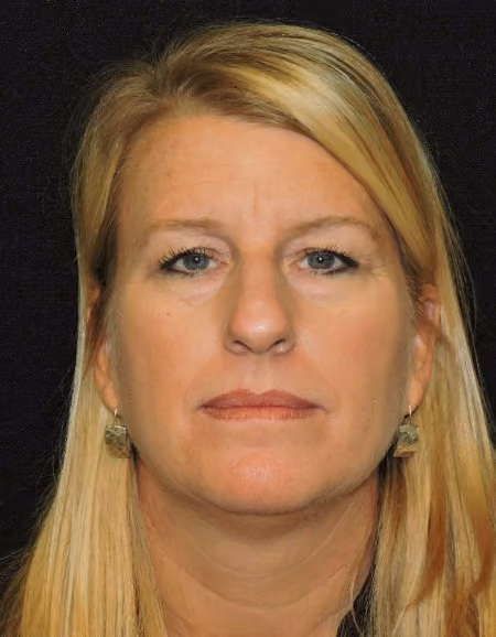 Eyelid Surgery before photo, case 1807 - Cool Springs Plastic Surgery
