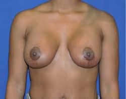Breast Lift + Augmentation after photo, case 1813 - Cool Springs Plastic Surgery