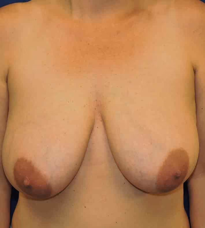 Breast Lift before photo, case 1912 - Cool Springs Plastic Surgery