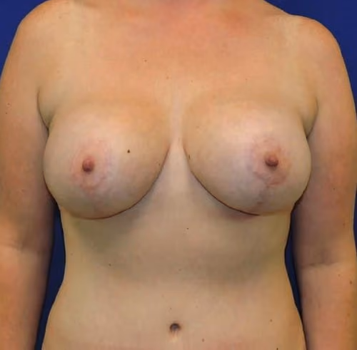 Breast Lift + Augmentation after photo, case 1946 - Cool Springs Plastic Surgery