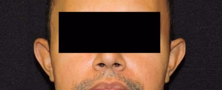 Ear Reshaping before photo, case 1970 - Cool Springs Plastic Surgery