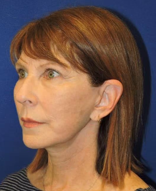 Facial Fat Grafting after photo, case 1979 - Cool Springs Plastic Surgery