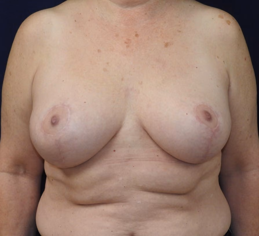 Breast Lift after photo, case 2015 - Cool Springs Plastic Surgery