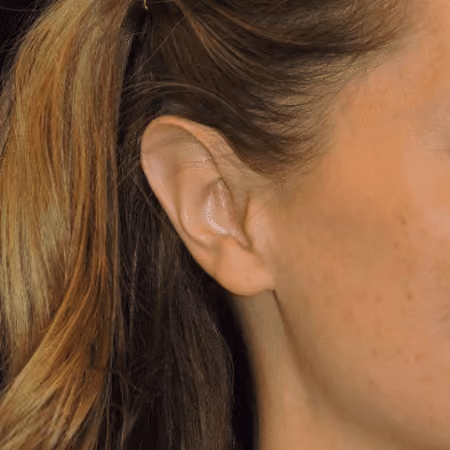Ear Reshaping before photo, case 2034 - Cool Springs Plastic Surgery